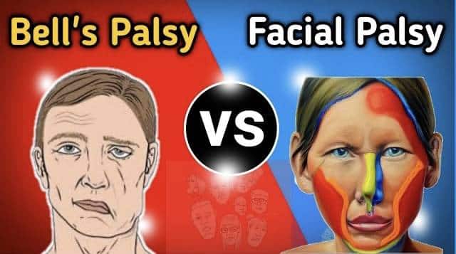 bells palsy and Facial palsy difference