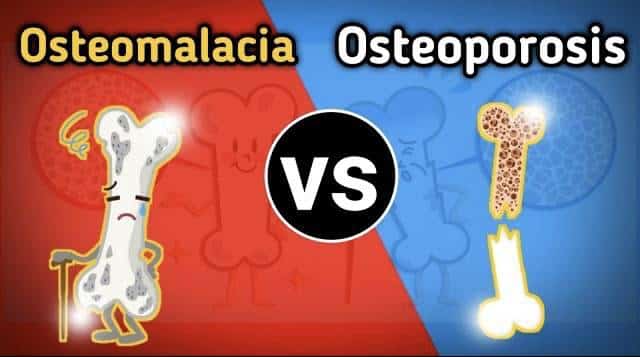 osteomalacia vs osteoporosis