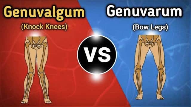 genuvalgum vs genuvarum