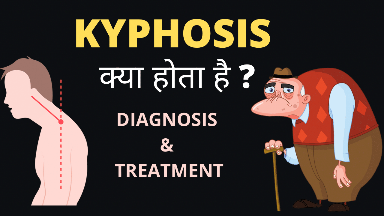 What is Kyphosis ?
