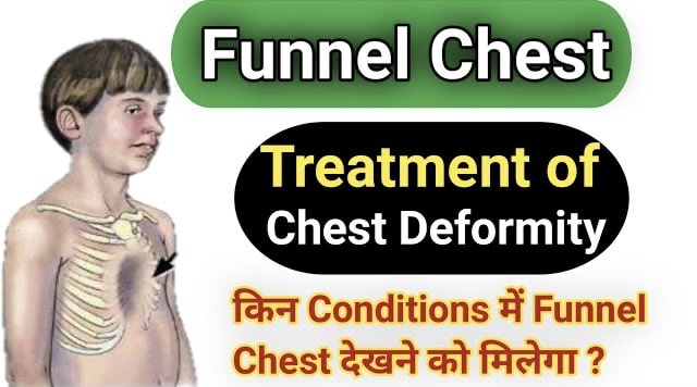 What is Funnel Chest ?