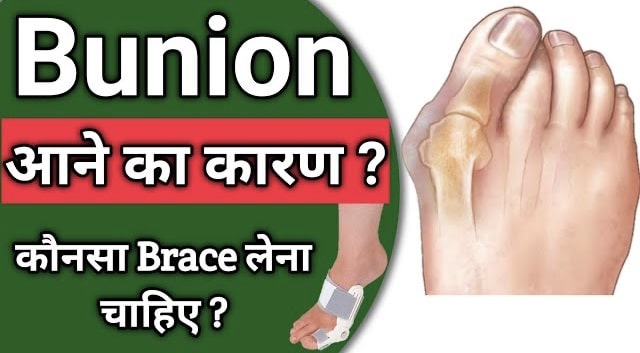 what is Bunion ?