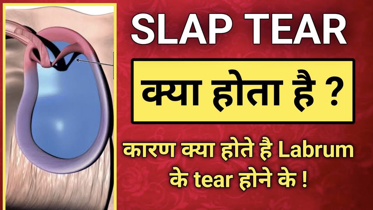 What is SLAP Tear ?