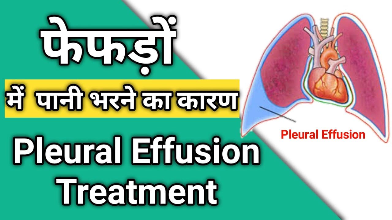 What is Pleural Effusion