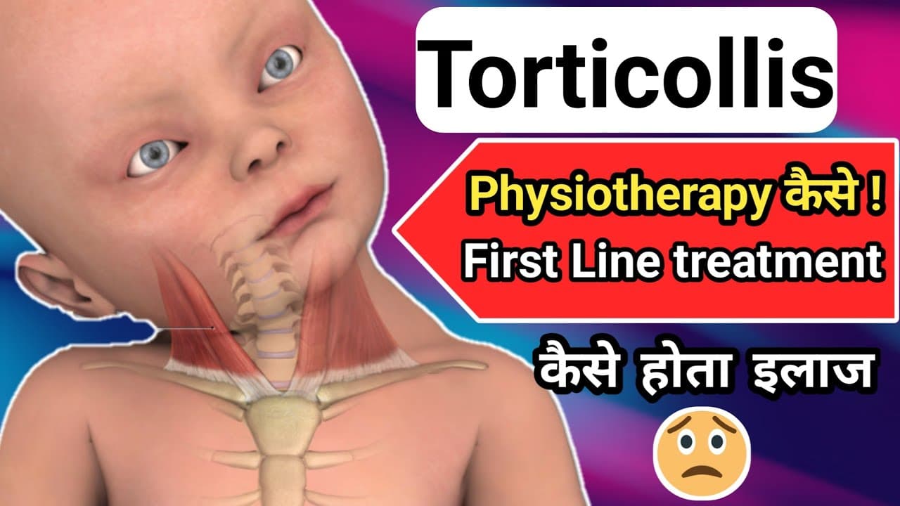 What is Torticollis ?