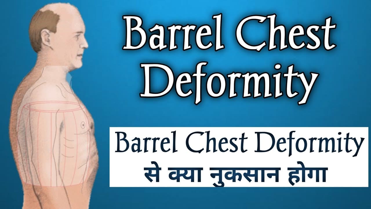 what is Barrel chest deformity ?