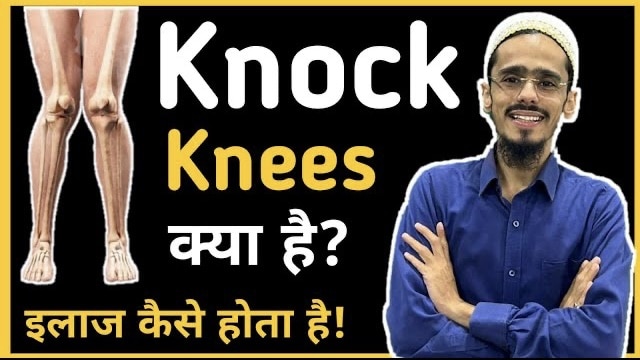What is Knock knees ?