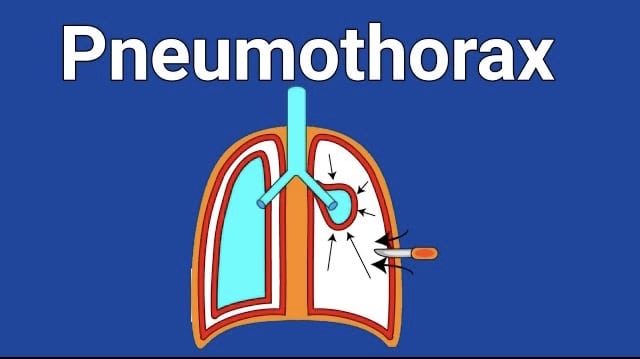 What is Pneumothorax ?