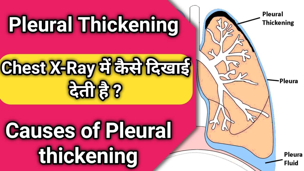 What is Pleural thickening ?