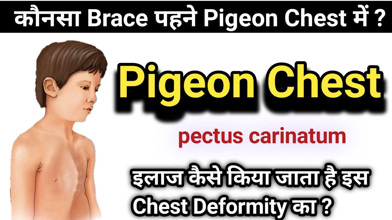 what is pigeon chest