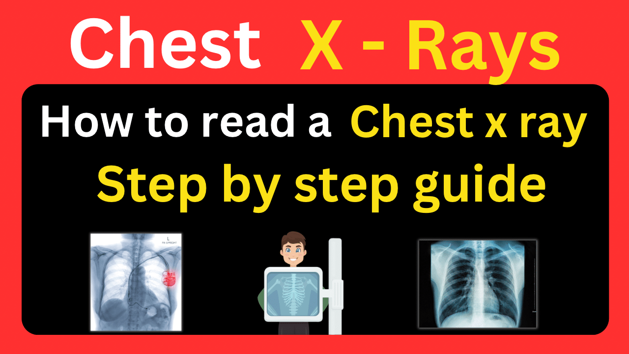 How to Read a Chest X-ray – Step By Step Guide