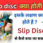 Slip Disc क्या है