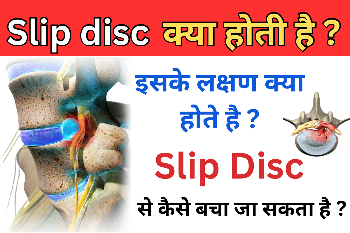 Slip Disc क्या है