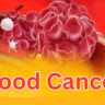 Early Signs of Blood Cancer