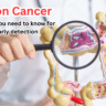 Colon Cancer What You Need to Know for Early Detection