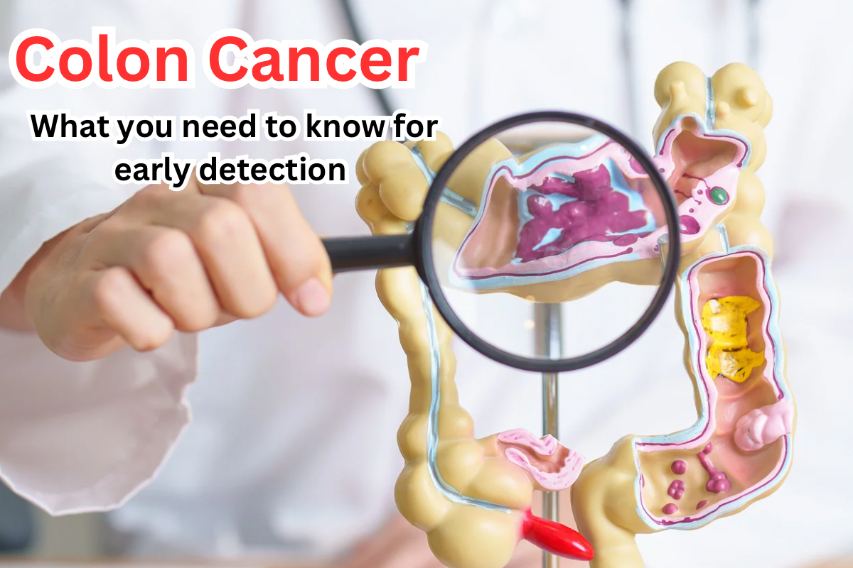 Colon Cancer What You Need to Know for Early Detection