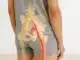 sciatica symptom checker